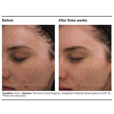 Набір для боротьби з акне PCA Skin The Acne Control Regimen - основне фото