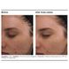 Набор для борьбы с акне PCA Skin The Acne Control Regimen - дополнительное фото