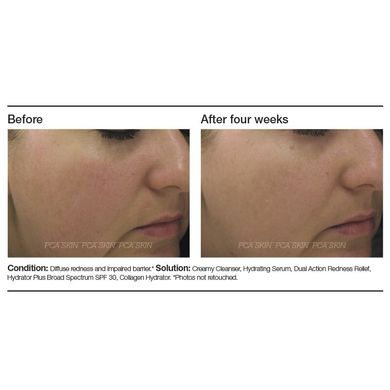 Успокаивающая сыворотка двойного действия PCA Skin Dual Action Redness Relief - основное фото